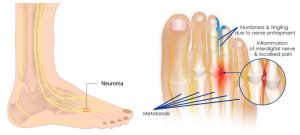 MORTON’S NEUROMA : What you need to know