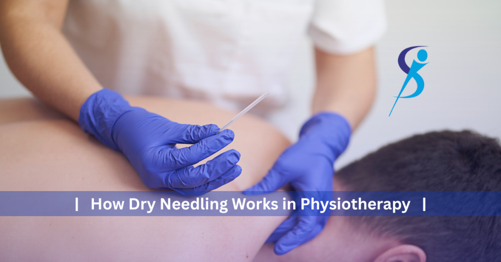 How Dry Needling Works in Physiotherapy