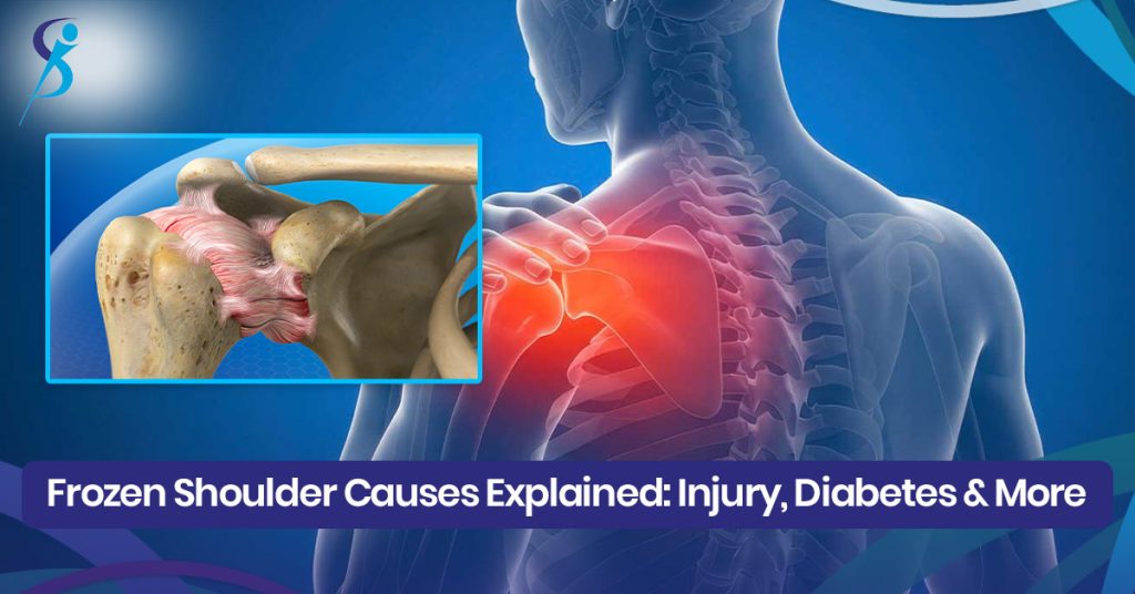 Frozen Shoulder Causes Explained blog image